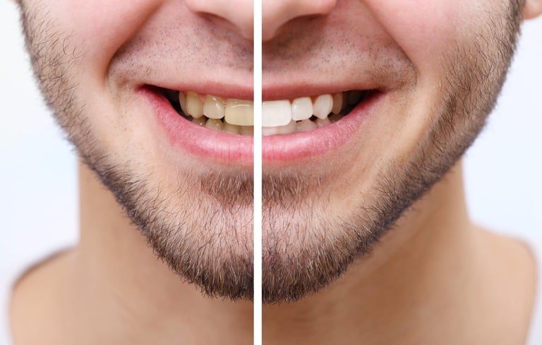 A photo showing teeth whitening before and after