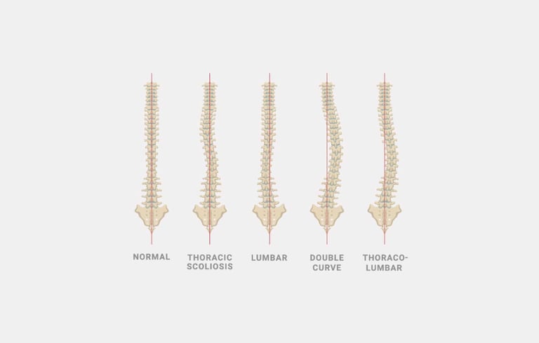Scoliosis treatment in precision center in Muscat.