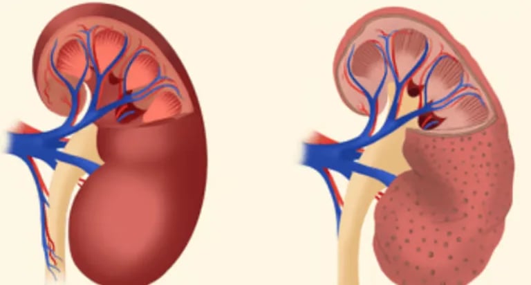 Best chronic kidney disease treatment in Madinaguda Hyderabad by leading nephrologist