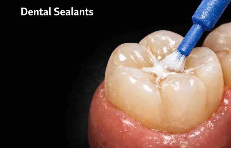 dental sealants