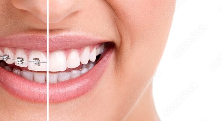 a woman with braces and braces on her teeth