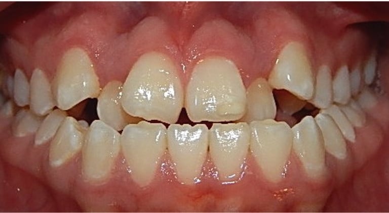 Close Up de una sonrisa con apiñamiento severo.