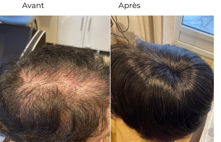 complément capillaire pas de calais