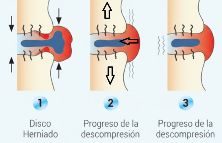 Proceso de reabsorción disco vertebral
