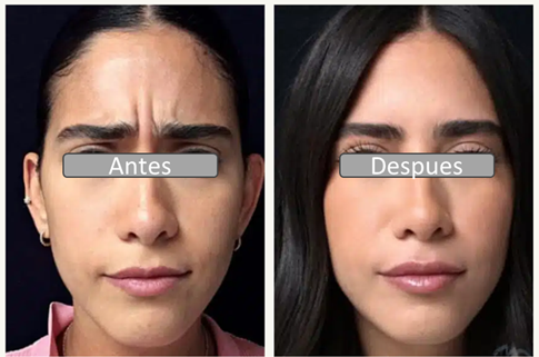 aplicacion botox ( toxina botulinica)