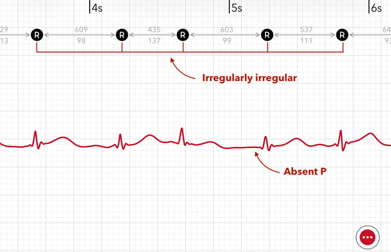 Atrial fibrillation is marked on Apple Watch ECG report showing Irregularly irregular beats