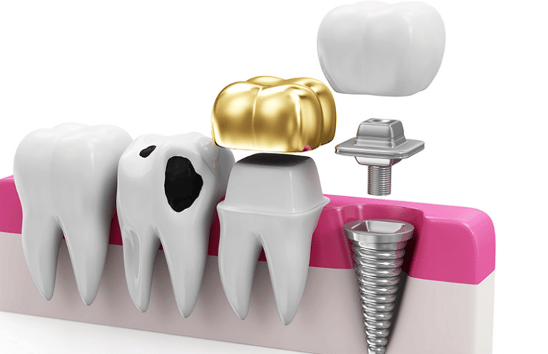restorative dental procedures