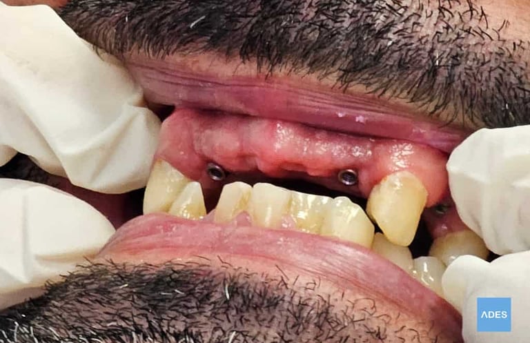 colocación implantes