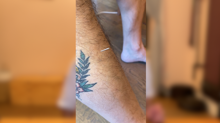 pic shows acu needle in shin muscle, Stomach 36. An american traditional tattoo reads "Heather"