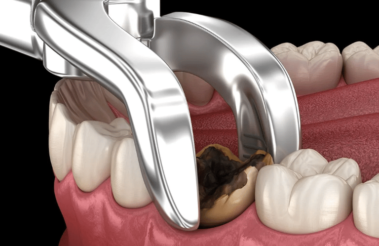 الخلع الجراحي والبسيط
