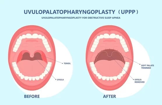 Uvulopalatopharyngoplasty