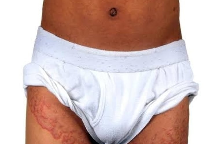 Person in underwear displaying stomach rash, in need of tinea treatment in Vadodara