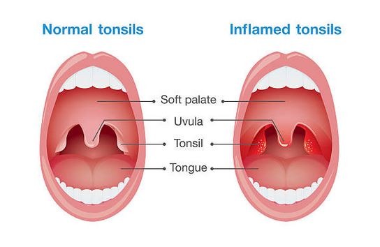 Tonsils
