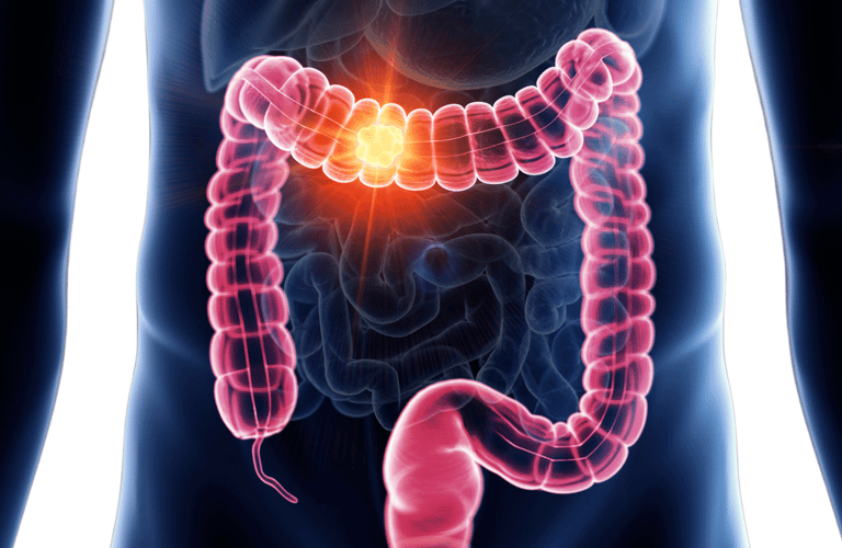 Colon cancer -Dr Maunil Tomar