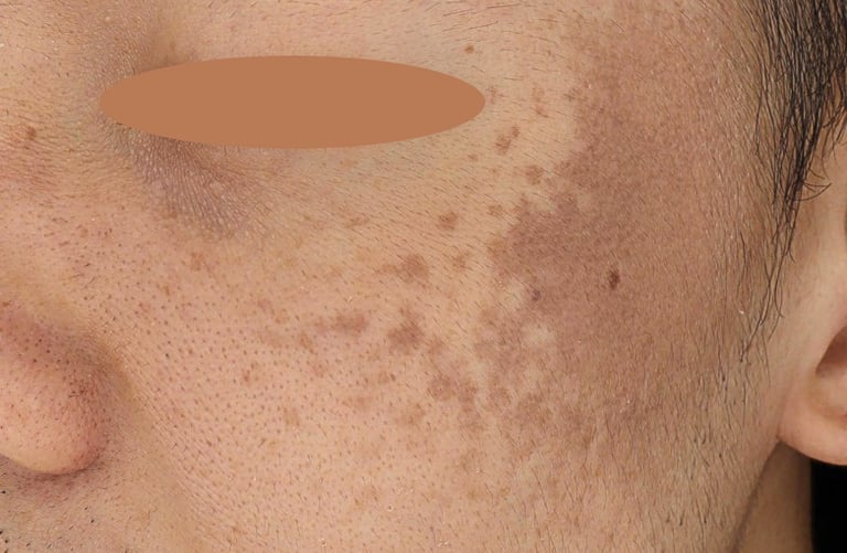 nevus of ota laser pigmentation removal