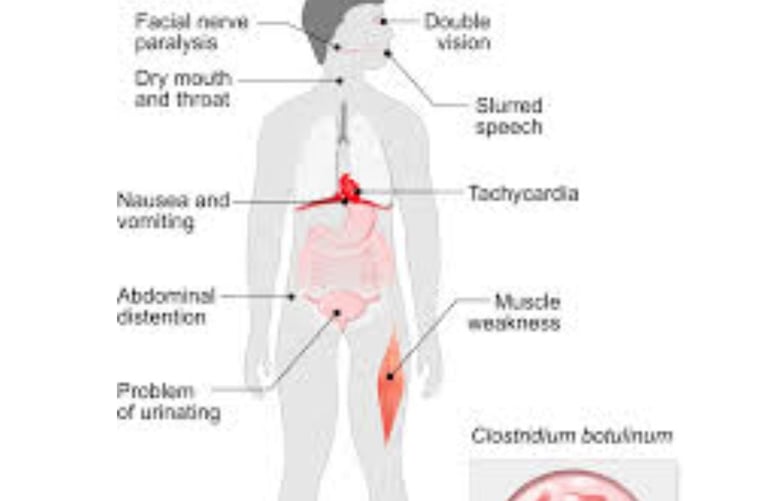 Botulism Separating Fact from Fiction (2)