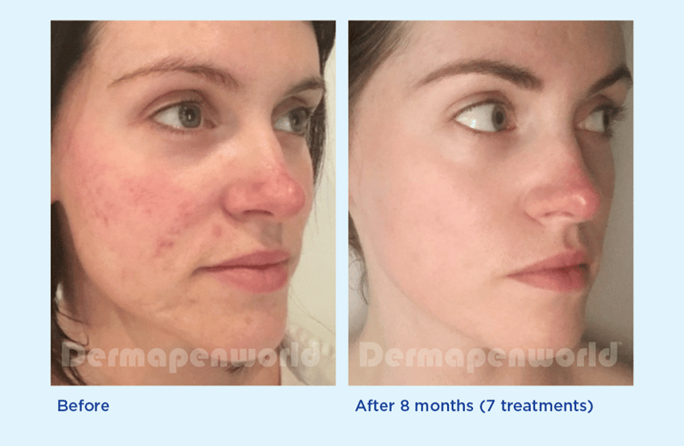 a person before and after dermapen 4 rosacea