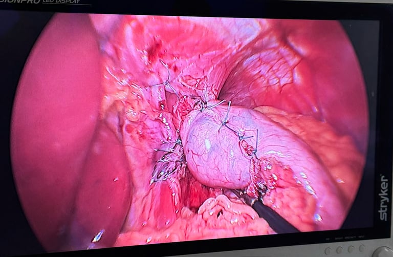 fotografia que mostra cirurgia de refluxo