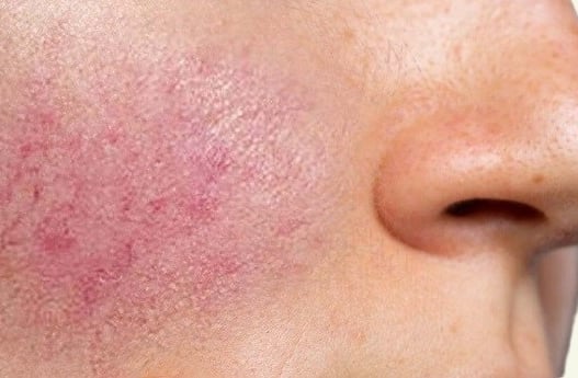 Rosacea in a young girl