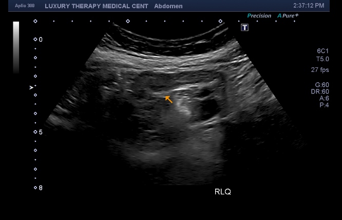Ultrasonido de abdomen para diagnóstico de apendicitis en Hialeah realizado en Luxury Therapy Ultras