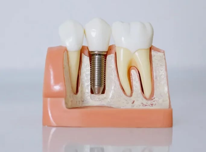 Mejores Implantes dentales en Sevilla