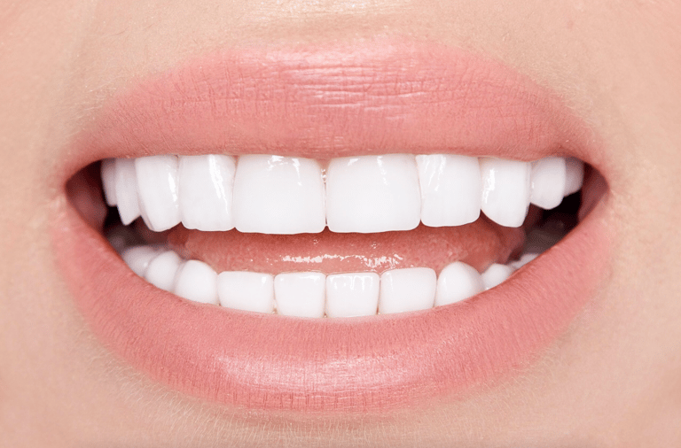 Veneers in Naples FL – Answers to Top Patient Questions by Dr. Kristina Taranov DDS