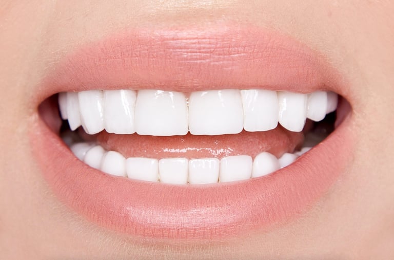 Veneers in Naples FL – Answers to Top Patient Questions by Dr. Kristina Taranov DDS
