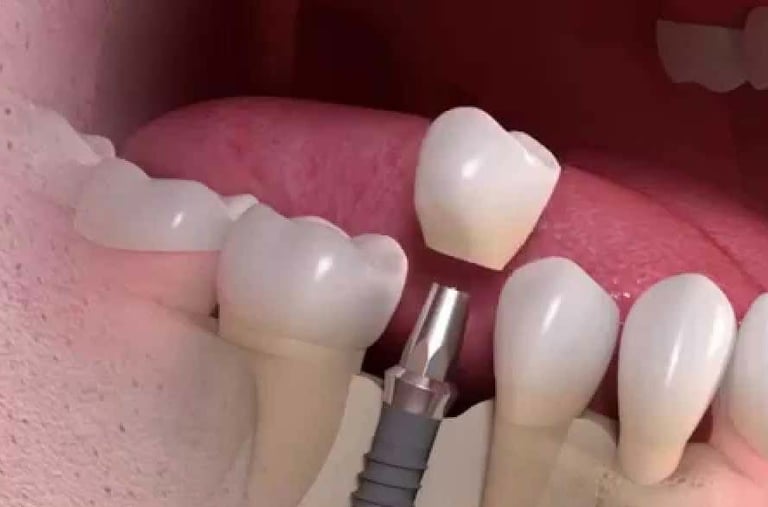 Beautify Your Smile With Dental Implants in Pune