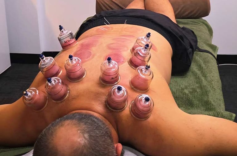 male with lots of cupping being done on his back in Wollongong