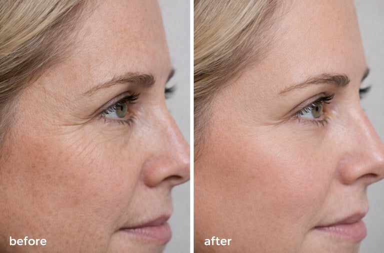 Natural Bio-Filler NY