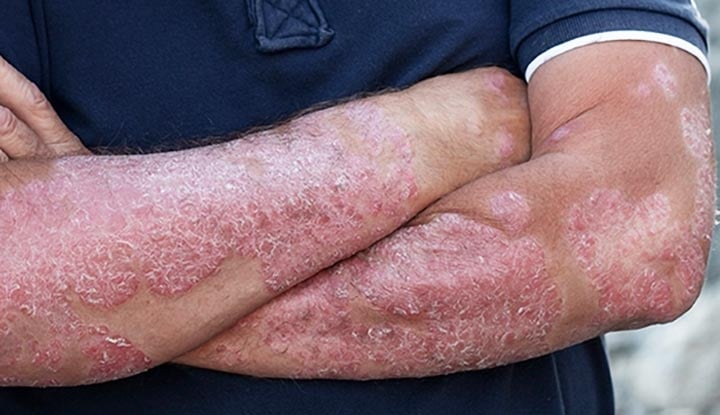 A man with psoriasis on his arms, seeking psoriasis treatment in Vadodara. Find the best dermatologist near you