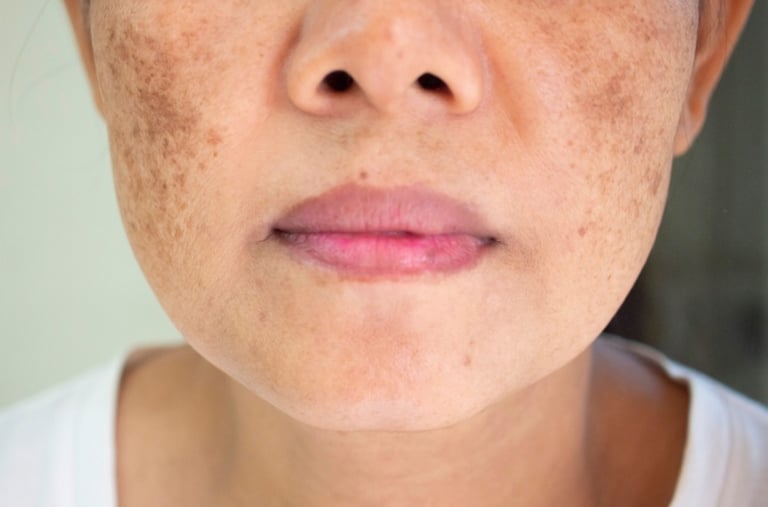 Melasma treatment in Vadodara at the best skin clinic near me