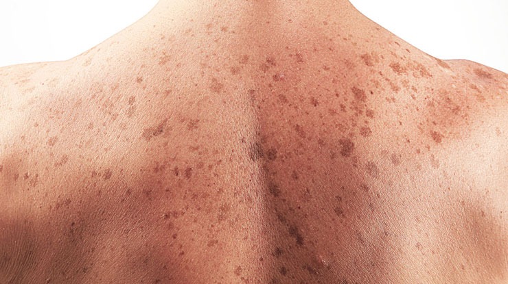 Pigmentation treatment in Vadodara for glowing skin. Visit the best skin clinic near you for effective glow treatment