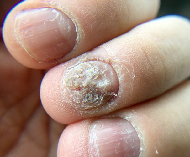  A person holding a nail with a white spot, symbolizing nail infection treatment in Vadodara by the best skin specialist