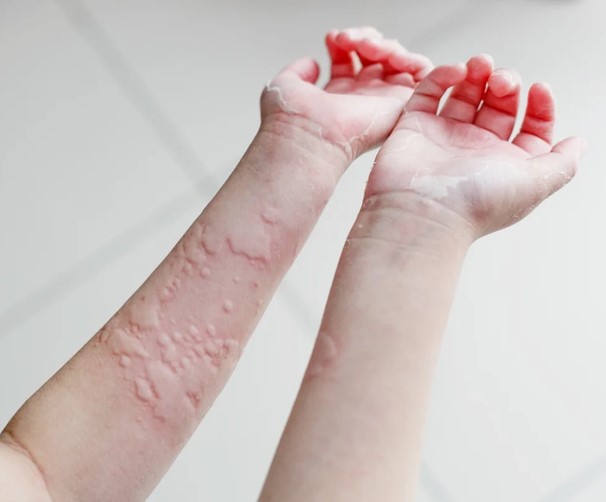Child with skin rash on hands, seeking urticaria treatment in Vadodara. Skin allergy treatment. Best skin specialist vadodara