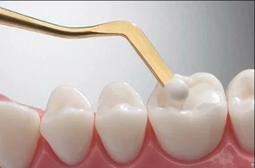 حشوات الأسنان