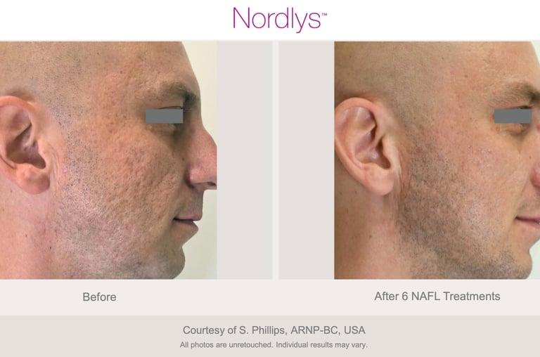 advanced skincare treatment for rough and uneven skin texture in Hamilton clinic