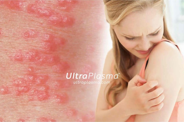 ultraplasma.com_Sarcoptes_scabiei_Infestation_Treatment_ultra_plasma_ultra_plazma