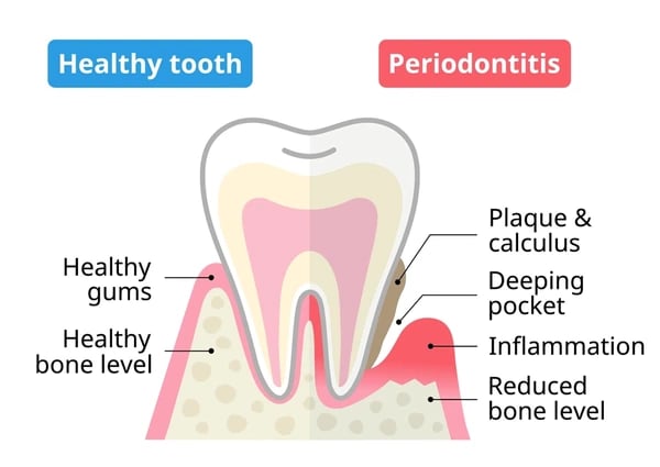 a image showing bone loss