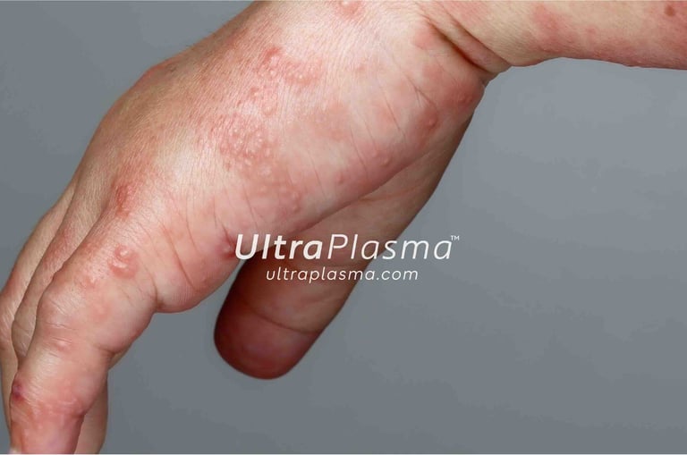 akne_acne_ultra_plasma_ultra_plazma_ultra-plasma_ultra-plazma
