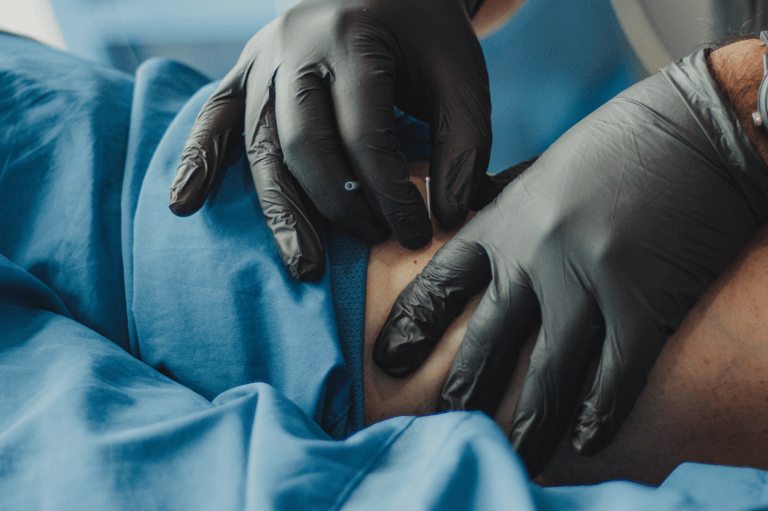 Acupuncture and Dry Needling for Pain Relief at Home