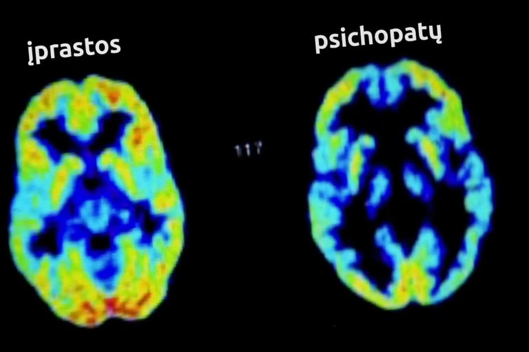Smegenų nuskenuotas paveiklas, palyginantis psichopato ir normalias smegenis. Normalios ryškios.