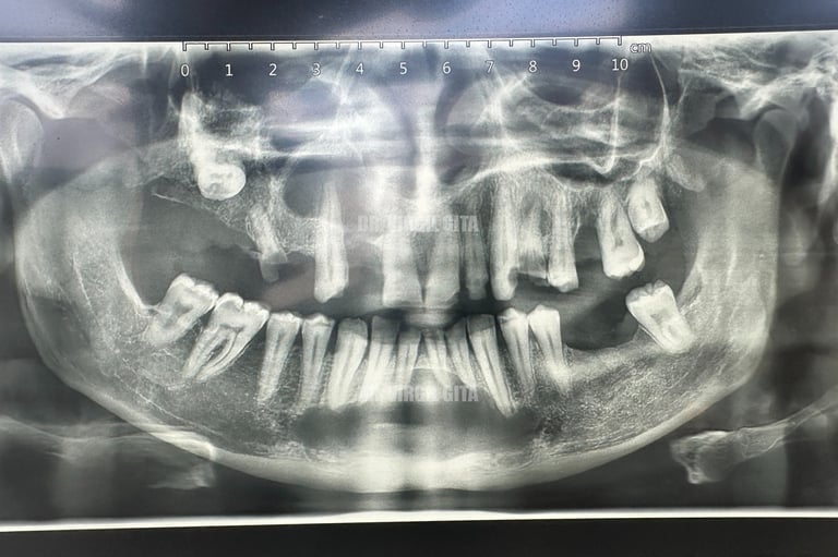 Radiografie chist mandibular