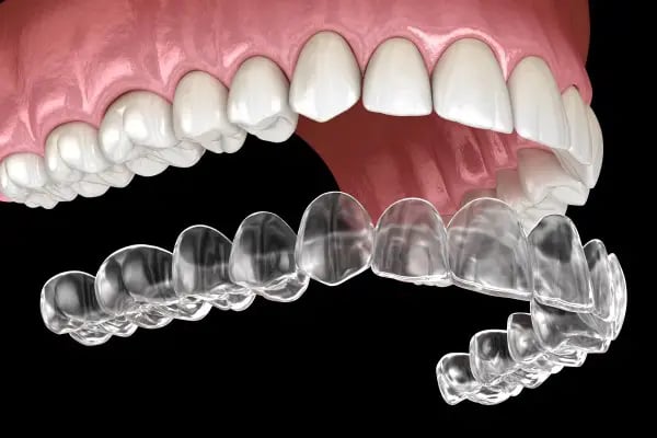 Invisalign Clear Orthodontics Greenville SC