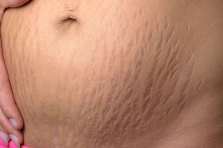 A woman's stomach with a prominent scar. Seek stretch mark treatment in Vadodara from the best skin specialist near you