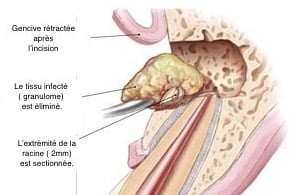 Chirurgie endodontique
