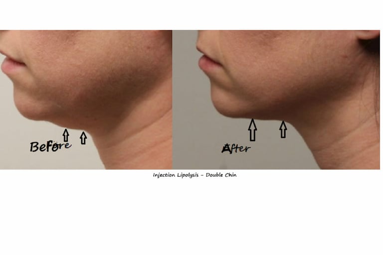 Fat reduction Delhi before and after photo – injection lipolysis double chin, male 20 yrs.