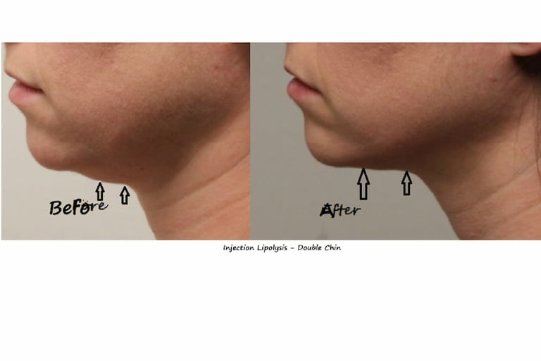 Fat reduction Delhi before and after photo – injection lipolysis double chin, male 20 yrs.