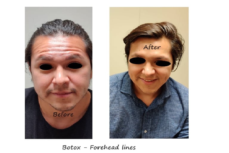 Före- och efterbild av botox i pannan - minskade rynkor och naturlig ögonbrynsform.
