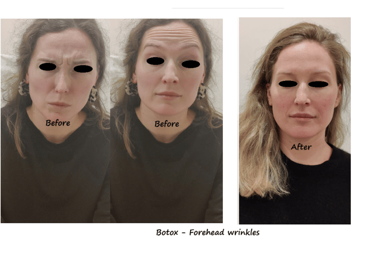 Botox treatment in the forehead and glabella – before and after photos showing reduced wrinkles.
